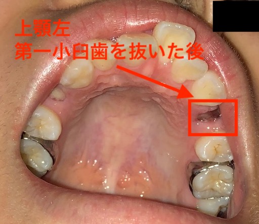 娘の歯列矯正の体験記 上顎の左第一小臼歯の抜歯 2本目の抜歯 J S Lab Builder